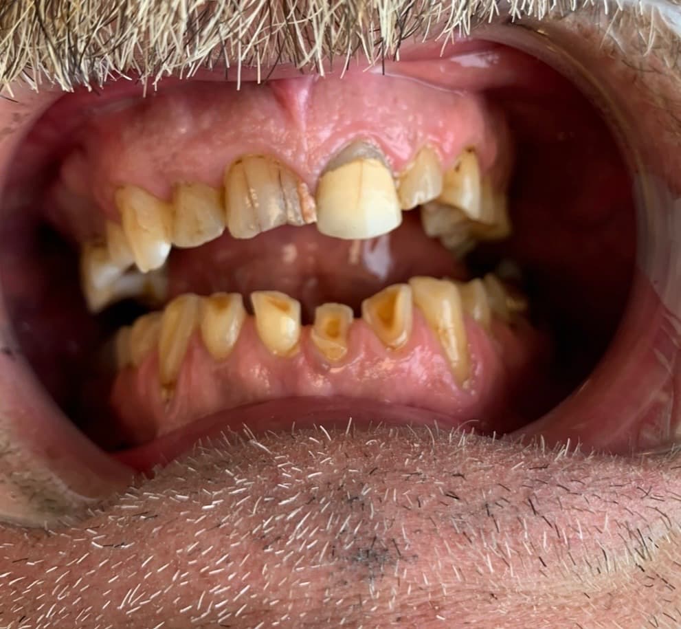 Before Treatment Smile