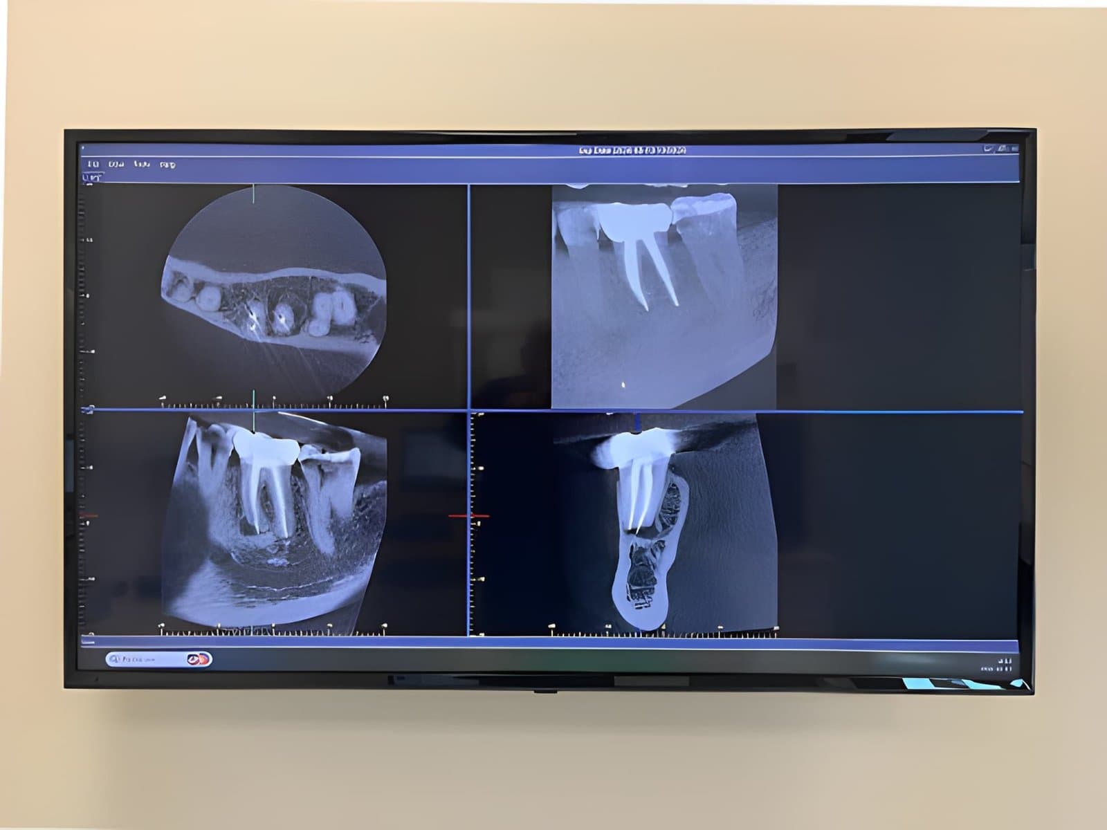 Root Canal in Wasilla: What to Expect, Step by Step