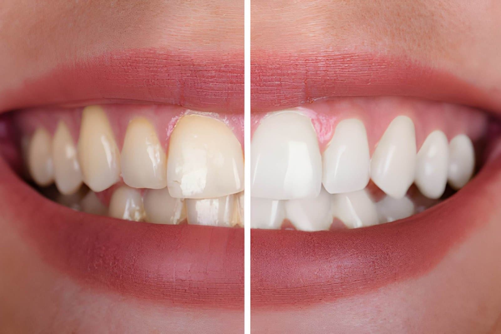 Are Teeth Whitening Treatments Safe? What Wasilla Patients Should Know